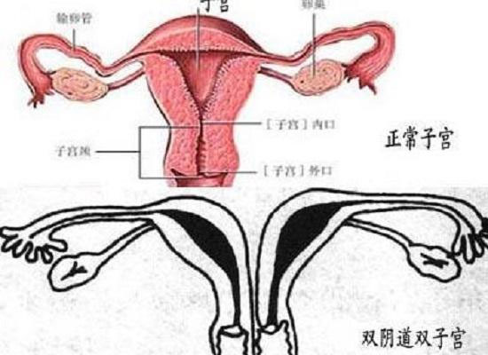 带你了解什么是纵膈子宫，别再和双子宫搞混了